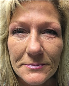 Eyelid Surgery Before Photo by Carlos Rivera-Serrano, MD; ,  - Case 43685