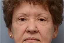 Eyelid Surgery Before Photo by Carlos Rivera-Serrano, MD; ,  - Case 43688