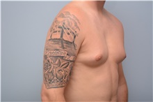 Male Breast Reduction Before Photo by Carlos Rivera-Serrano, MD; ,  - Case 43710