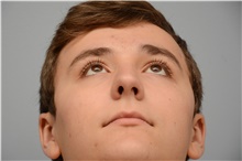Rhinoplasty After Photo by Carlos Rivera-Serrano, MD; ,  - Case 43724