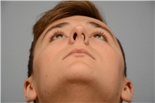 Rhinoplasty Before Photo by Carlos Rivera-Serrano, MD; ,  - Case 43724