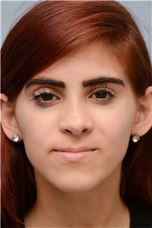 Rhinoplasty After Photo by Carlos Rivera-Serrano, MD; ,  - Case 43736