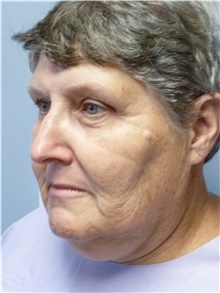 Rhinoplasty Before Photo by Carlos Rivera-Serrano, MD; ,  - Case 43740