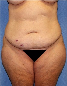 Body Lift Before Photo by Siamak Agha, MD PhD FACS; ,  - Case 43878