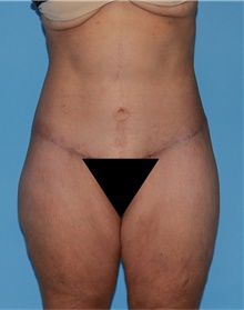 Body Lift After Photo by Siamak Agha, MD PhD FACS; ,  - Case 43879