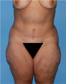 Body Lift Before Photo by Siamak Agha, MD PhD FACS; ,  - Case 43879