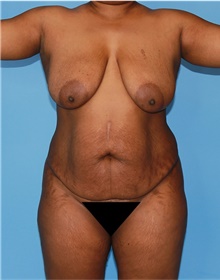 Mommy Makeover Before Photo by Siamak Agha, MD PhD FACS; ,  - Case 43901