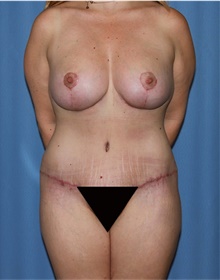 Mommy Makeover After Photo by Siamak Agha, MD PhD FACS; ,  - Case 43905