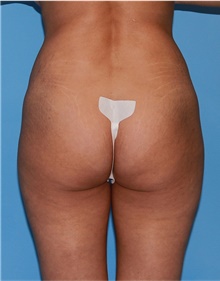 Buttock Lift with Augmentation Before Photo by Siamak Agha, MD PhD FACS; ,  - Case 43918