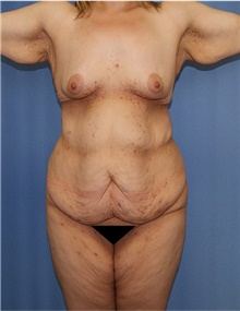 Body Lift Before Photo by Siamak Agha, MD PhD FACS; ,  - Case 43931