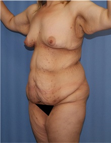 Body Lift Before Photo by Siamak Agha, MD PhD FACS; ,  - Case 43931