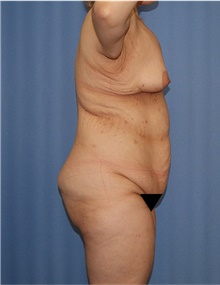 Body Lift Before Photo by Siamak Agha, MD PhD FACS; ,  - Case 43931