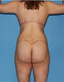 Body Lift After Photo by Siamak Agha, MD PhD FACS; ,  - Case 43931