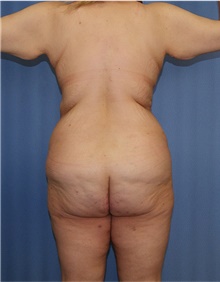 Body Lift Before Photo by Siamak Agha, MD PhD FACS; ,  - Case 43931