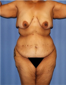 Body Lift Before Photo by Siamak Agha, MD PhD FACS; ,  - Case 43938
