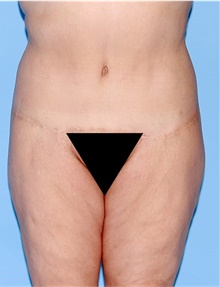 Body Lift After Photo by Siamak Agha, MD PhD FACS; ,  - Case 43943