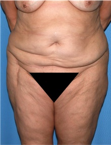 Body Lift Before Photo by Siamak Agha, MD PhD FACS; ,  - Case 43943