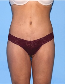 Body Lift After Photo by Siamak Agha, MD PhD FACS; ,  - Case 43945