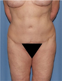Body Lift Before Photo by Siamak Agha, MD PhD FACS; ,  - Case 43947