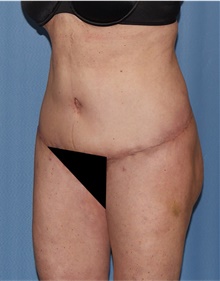 Body Lift After Photo by Siamak Agha, MD PhD FACS; ,  - Case 43947