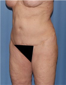Body Lift Before Photo by Siamak Agha, MD PhD FACS; ,  - Case 43947