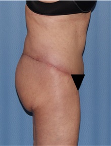 Body Lift After Photo by Siamak Agha, MD PhD FACS; ,  - Case 43947