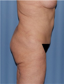 Body Lift Before Photo by Siamak Agha, MD PhD FACS; ,  - Case 43947