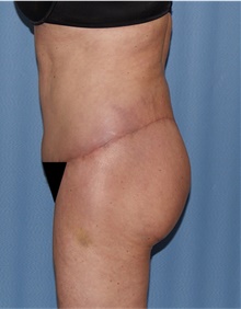 Body Lift After Photo by Siamak Agha, MD PhD FACS; ,  - Case 43947