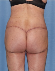 Body Lift After Photo by Siamak Agha, MD PhD FACS; ,  - Case 43947