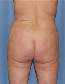Body Lift Before Photo by Siamak Agha, MD PhD FACS; ,  - Case 43947