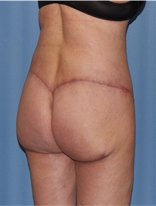 Body Lift After Photo by Siamak Agha, MD PhD FACS; ,  - Case 43947