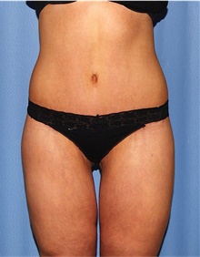 Body Lift After Photo by Siamak Agha, MD PhD FACS; ,  - Case 43950