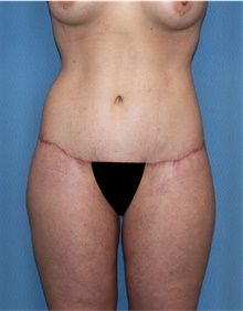 Body Lift After Photo by Siamak Agha, MD PhD FACS; ,  - Case 43951