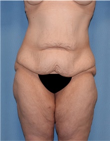 Body Lift Before Photo by Siamak Agha, MD PhD FACS; ,  - Case 43951