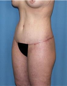 Body Lift After Photo by Siamak Agha, MD PhD FACS; ,  - Case 43951