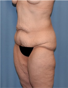 Body Lift Before Photo by Siamak Agha, MD PhD FACS; ,  - Case 43951