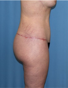 Body Lift After Photo by Siamak Agha, MD PhD FACS; ,  - Case 43951