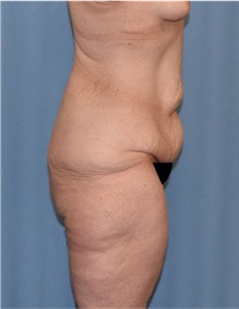 Body Lift Before Photo by Siamak Agha, MD PhD FACS; ,  - Case 43951