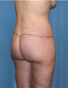Body Lift After Photo by Siamak Agha, MD PhD FACS; ,  - Case 43951