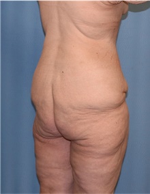 Body Lift Before Photo by Siamak Agha, MD PhD FACS; ,  - Case 43951