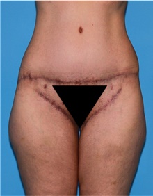 Body Lift Before Photo by Siamak Agha, MD PhD FACS; ,  - Case 43953