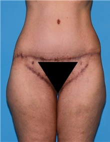 Body Lift Before Photo by Siamak Agha, MD PhD FACS; ,  - Case 43953