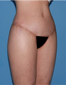 Body Lift After Photo by Siamak Agha, MD PhD FACS; ,  - Case 43953