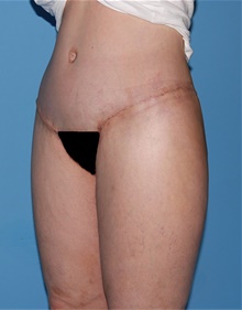 Body Lift After Photo by Siamak Agha, MD PhD FACS; ,  - Case 43953