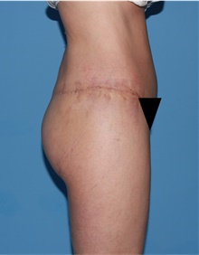 Body Lift After Photo by Siamak Agha, MD PhD FACS; ,  - Case 43953