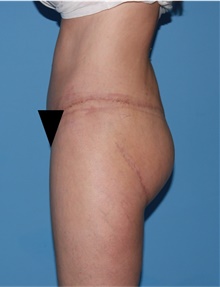Body Lift After Photo by Siamak Agha, MD PhD FACS; ,  - Case 43953