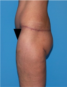 Body Lift Before Photo by Siamak Agha, MD PhD FACS; ,  - Case 43953