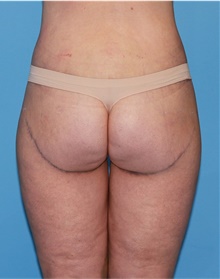 Body Lift After Photo by Siamak Agha, MD PhD FACS; ,  - Case 43953