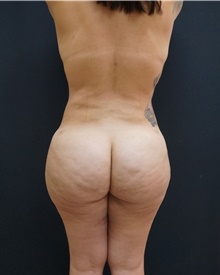 Buttock Lift with Augmentation After Photo by Johnny Franco, MD; ,  - Case 43972