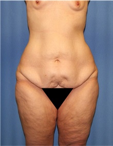 Body Lift Before Photo by Siamak Agha, MD PhD FACS; ,  - Case 43977